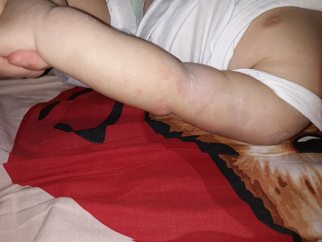 eczema/prickly heat or skin allergy ?