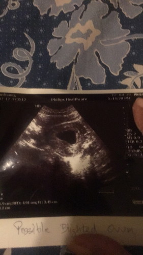 สวัสดีค่ะทุกคน นีมีเรื่องรบกวนสอบถาม เมื่อสัปดาห์ที่แล้ว ครบ8 สัปดาห์ เลยไปฝากท้อง หมอซาวด์หน้าท้อง หมอ ไม่เจอตัวอ่อน หมอเลยสันนิฐานว่าน่าจะท้องลม แต่ ก็นัดมาตรวจอีก คือเมื่อวาน ครบ1อาท