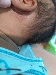 ลูกชายมีเม้ดขึ้นที่หน้า หัว และหู บางเม้ดเหมิอนสิวพอง