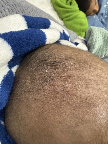 แม่ๆคะน้องเป็นแบบนี้เกิดจากอะไรคะ ผมสระให้ทุกวัน เกาด้วยแต่ไม่ได้เกาแรงมาก