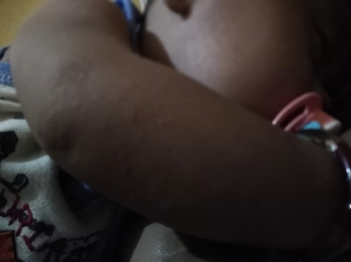 tangan bentol2 kecil, ada merahnya juga agk besar