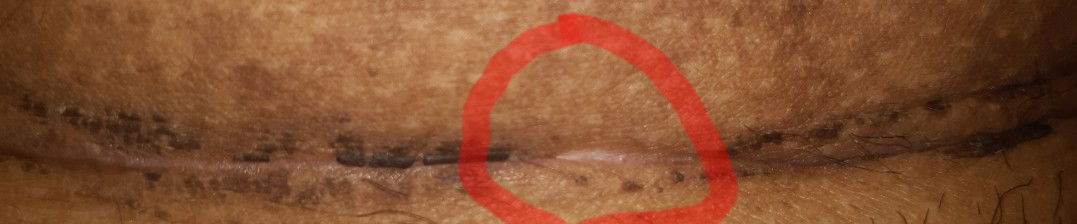 Bekas luka SC seperti ini apakah sudah sembuh