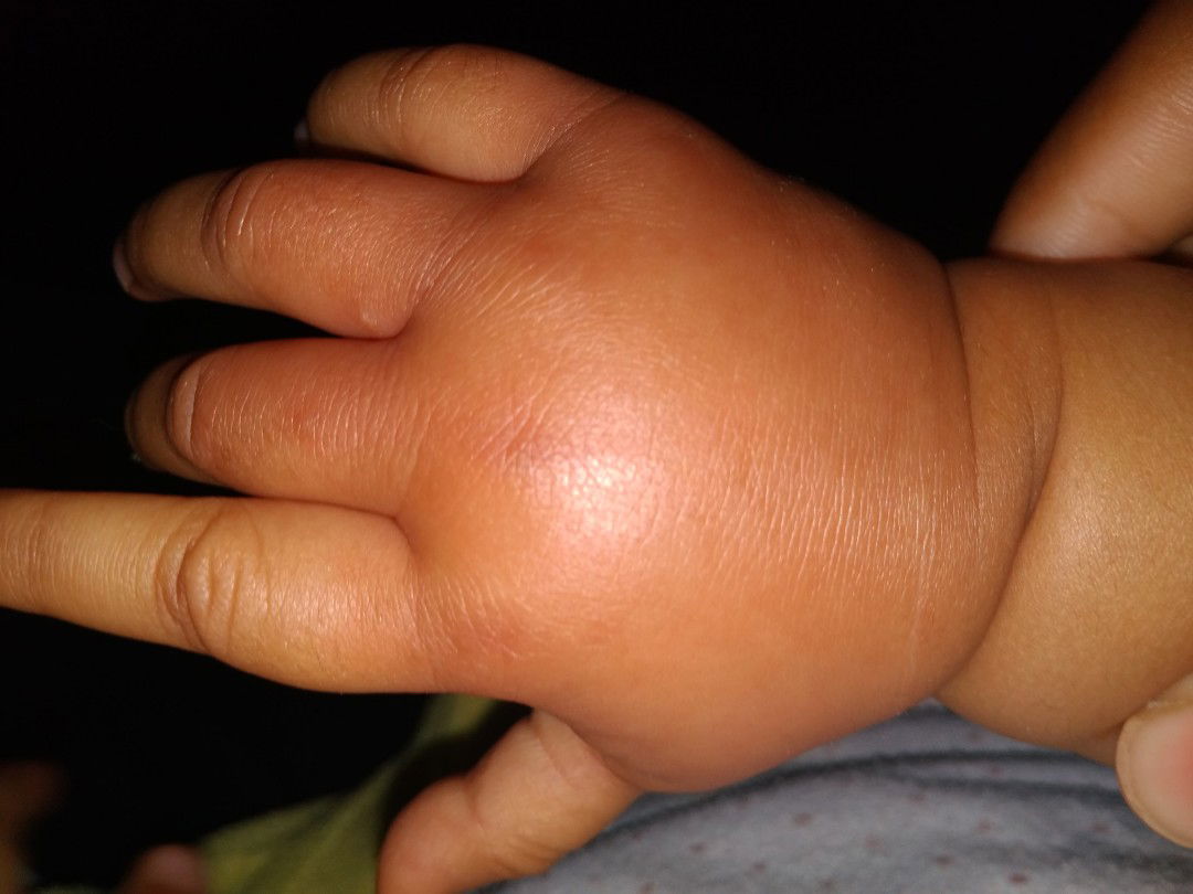 tangan baby bengkak