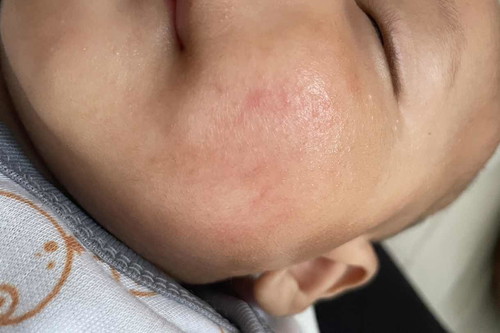Kondisi kulit bayi