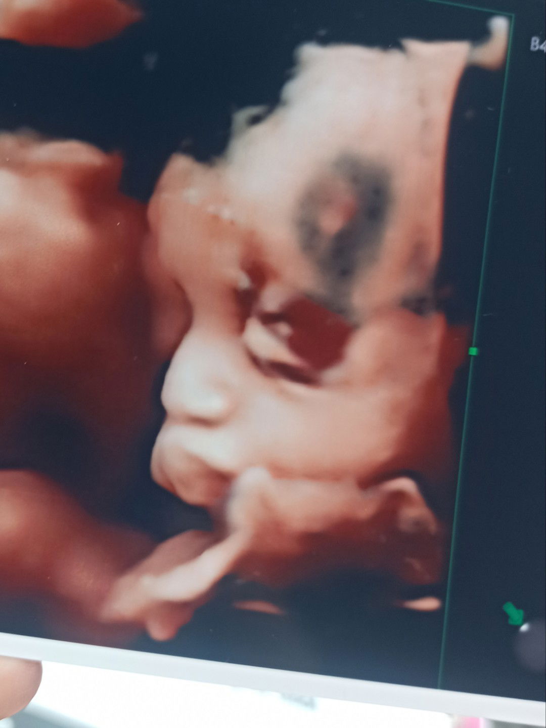 Hitam di jidat saat usg 4d