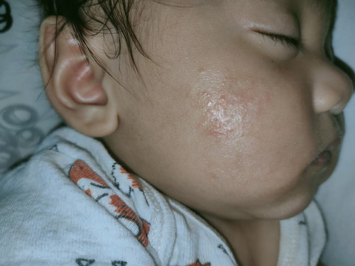 rashes sa face ni LO