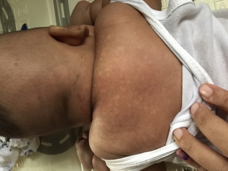 Bercak putih di tubuh bayi