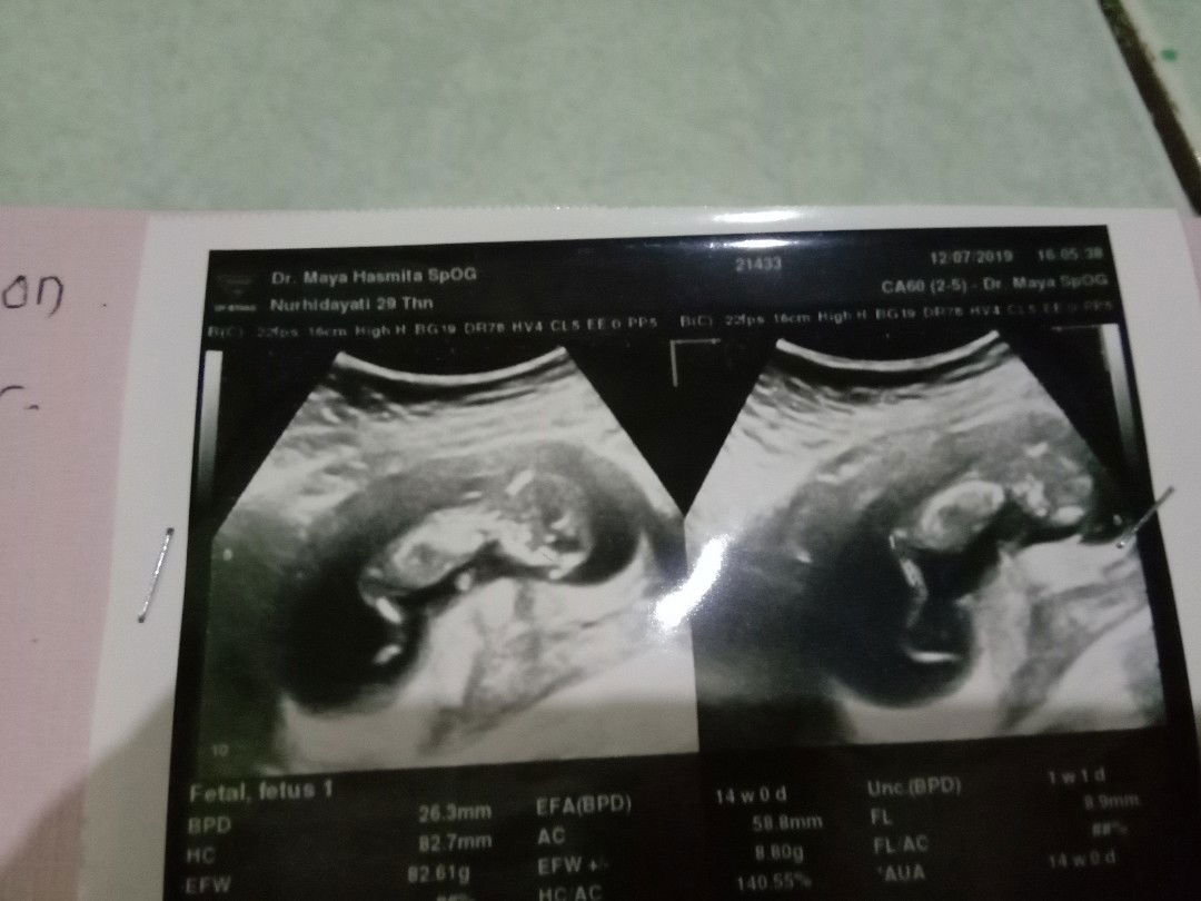 14 Week berat janin 8 gr