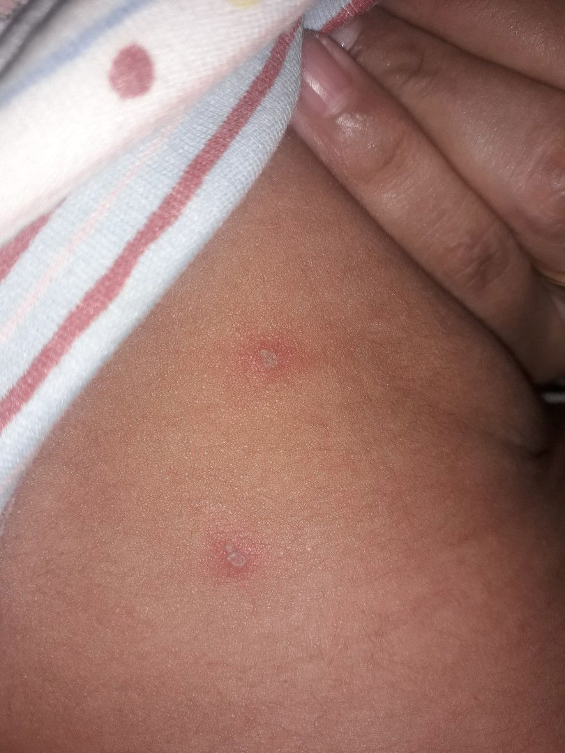 Cacar air bayi 3bulan