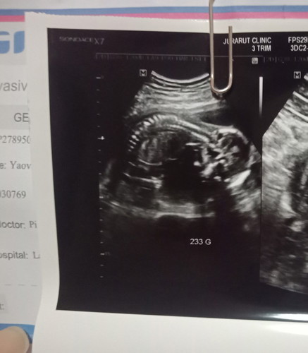 ท้อง 18 วีค ลูกนอนขวางอันตรายมั้ยคะ