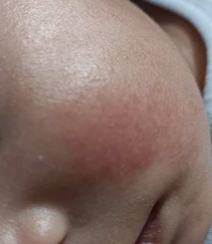 Rashes on face // My baby has Atopic Dermatitis