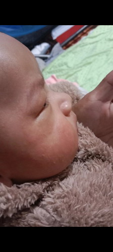 หน้าน้องเป็นผื่นเป็นๆหายๆ