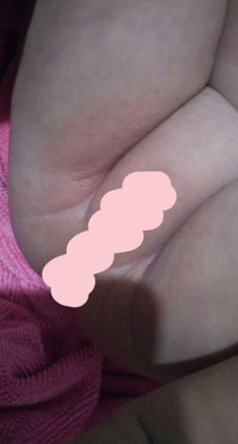 ผื่นผ้าอ้อม???