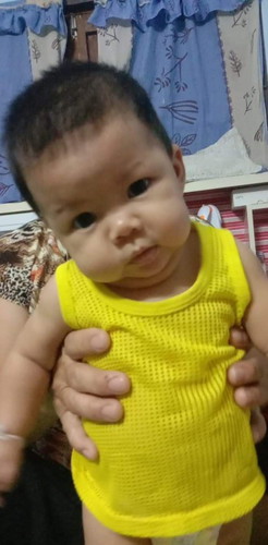 น้องคอเอียง