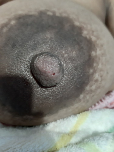 Namumula nipple