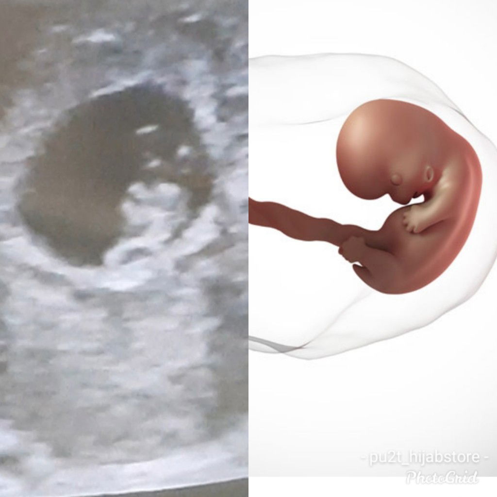 stelah keguguran hamil langsung