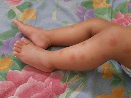 bentol merah & membekas