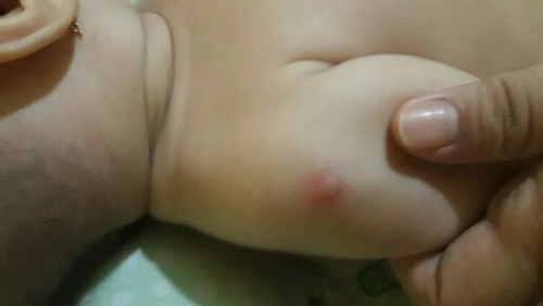 bengkak bekas imunisasi