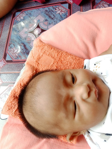 Warna kulit tidak merata atau tanda lahir ya bunda2?
Bisa hilang kah pas di dahi keliatan gak rata?