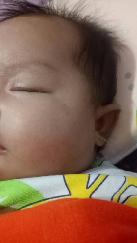 bekas luka bayi 1,5 bln