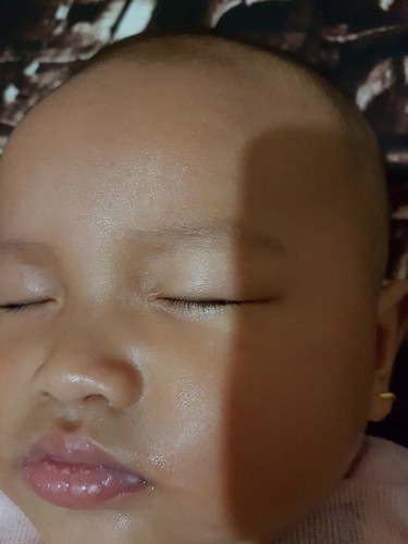 Bercak Putih pada mulut bayi