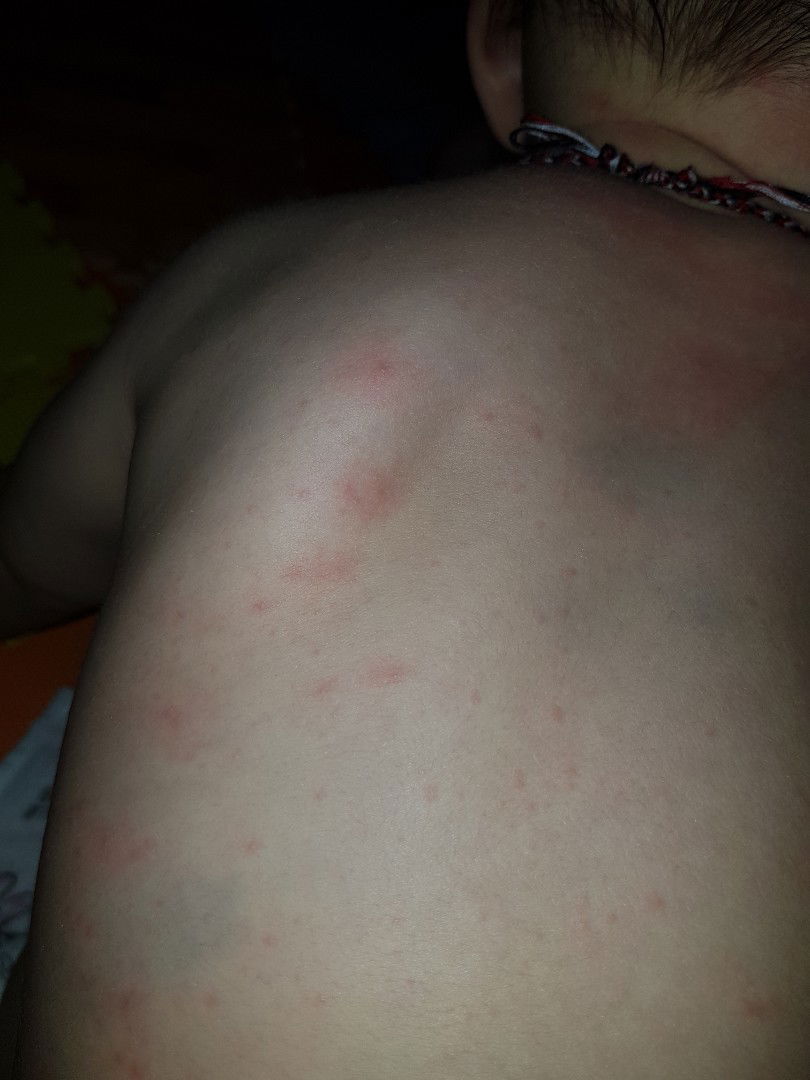 bintik merah pada bayi