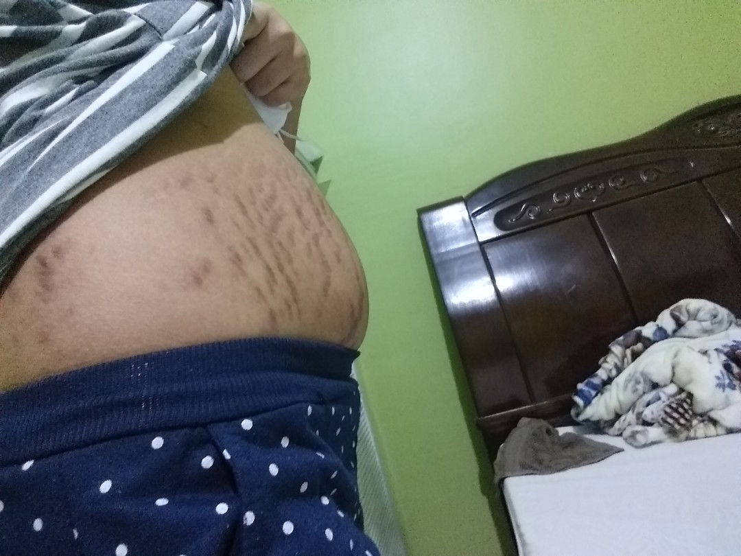 stretch marks