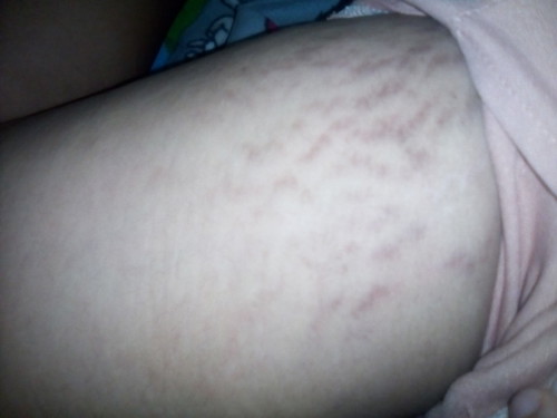 ขาลาย