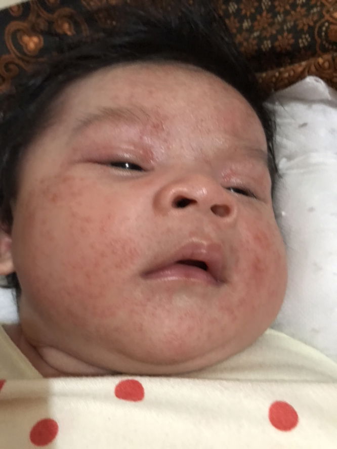 Bintik merah pada muka anak