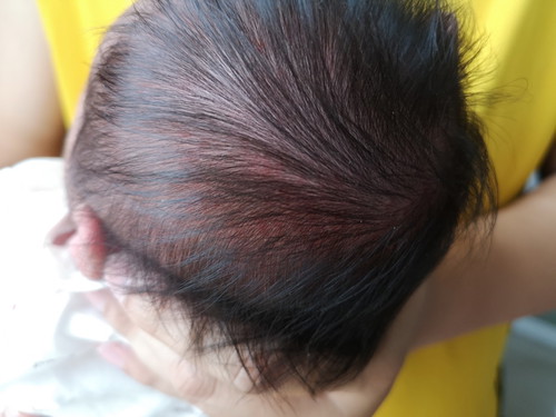ผื่นแดงขึ้นที่หัว