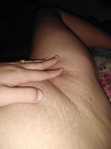 ท้องแตกลาย