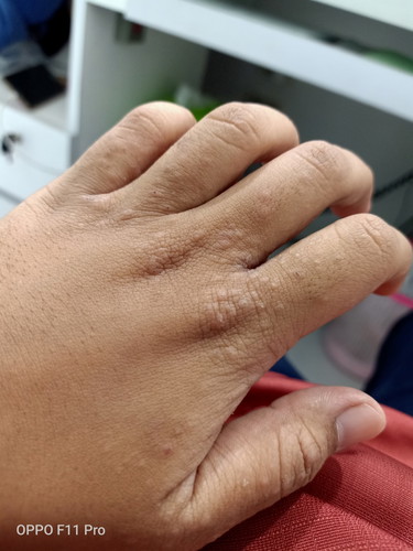 gatal gatal seluruh badan