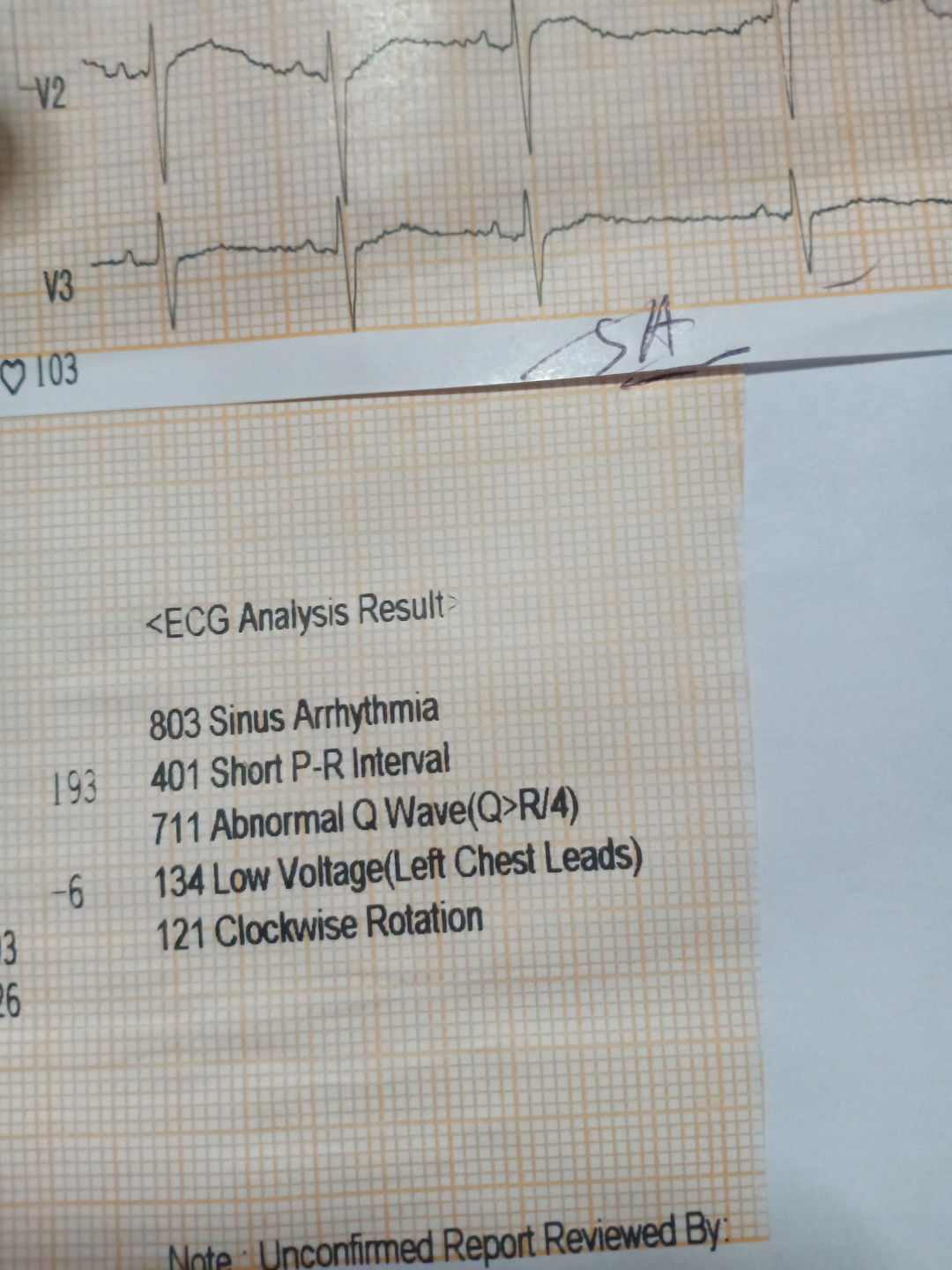 ECG Result