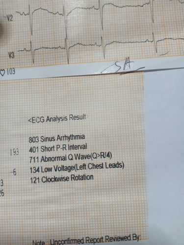 ECG Result