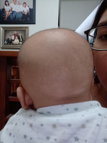 kulit kepala bayi tiba-tiba putih
