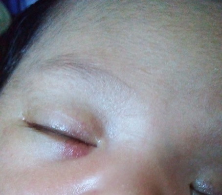 bawah mata Newborn merah