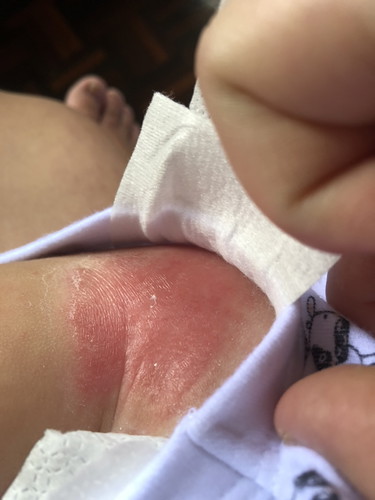 eczema/ruam?