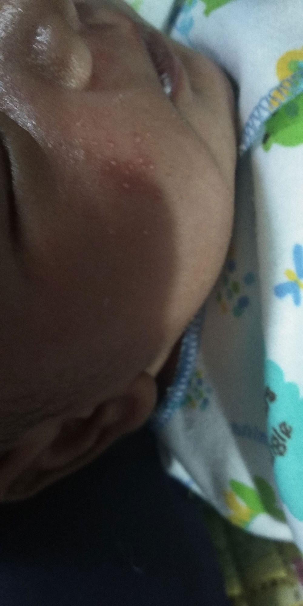 Bruntusan atau eksim?