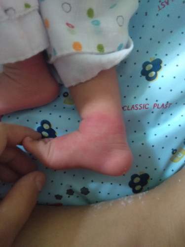 เท้าบวมเเดง