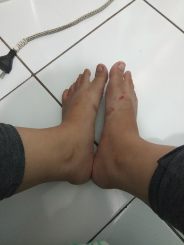 kaki bengkak