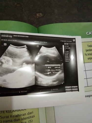 Hasil usg?