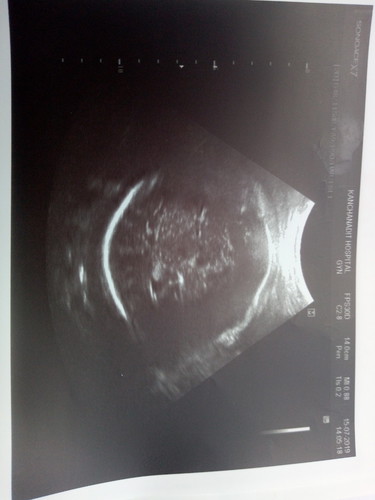 ผลซาววันนี้37w3d