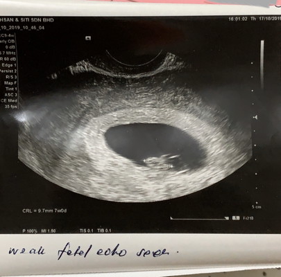 Memgandung selepas gugur