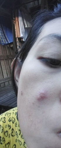 bunda bunda mau tanya . skincare apa sih yg dpake kalau bumil jerawat batu .