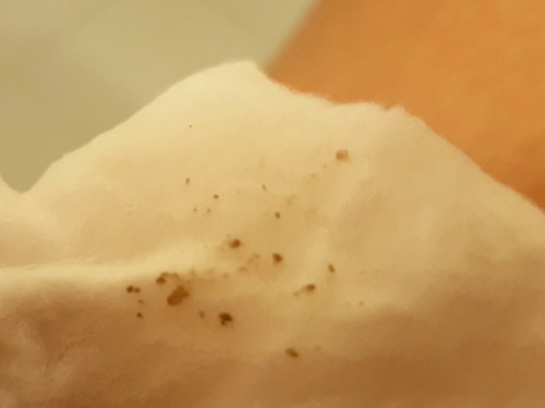 มีเศษเหมือนขี้ไคลออกจากหัวนม