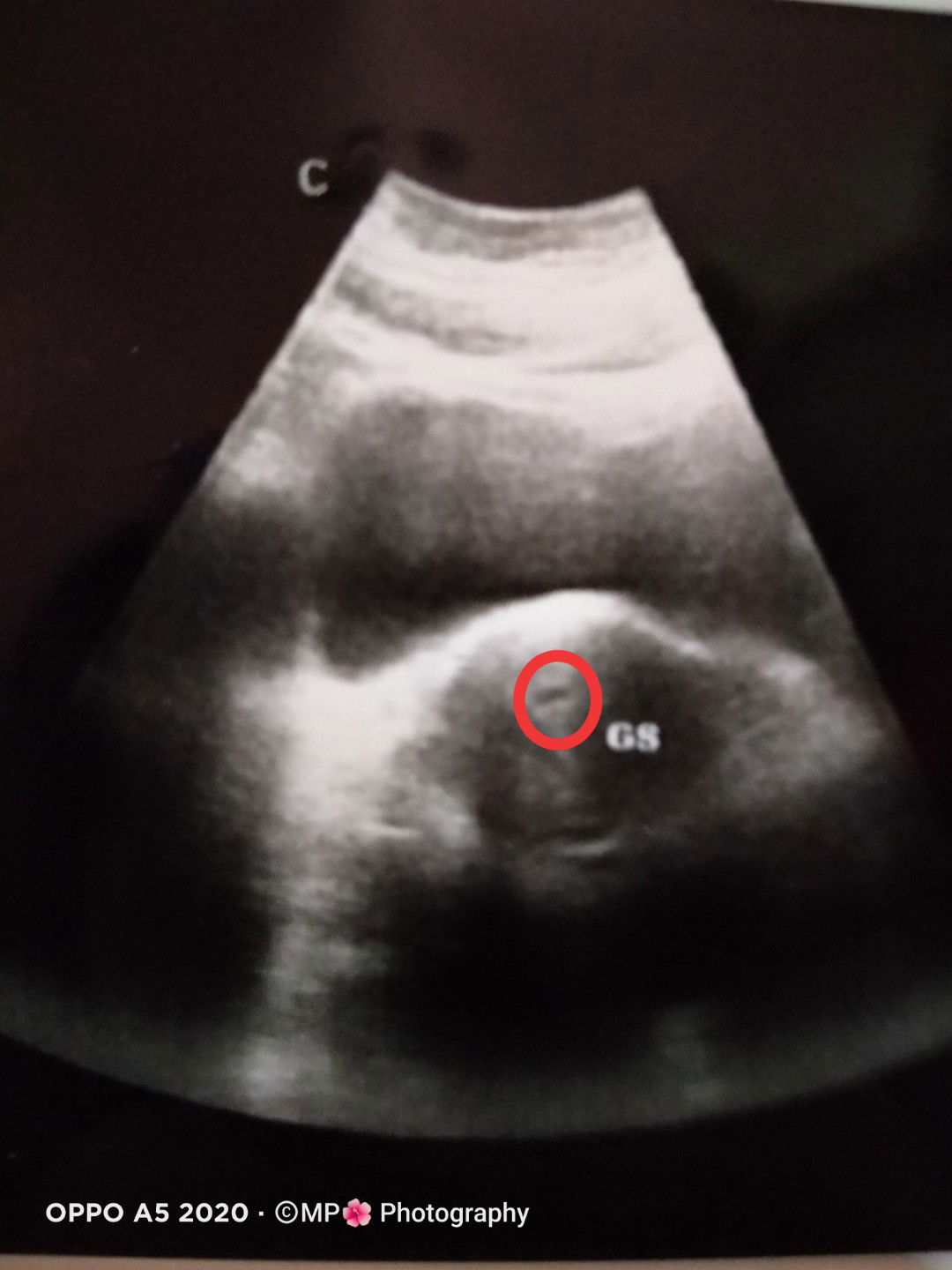 Keputihan Serat Darah