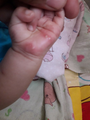 gatal berair pada bayi 3 bln
