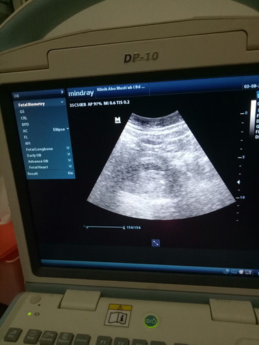 baca hasil usg