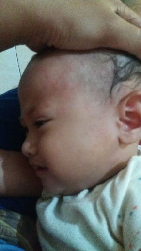 Muka Dan Badan Bintik2 Merah