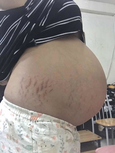 Stretchmarks